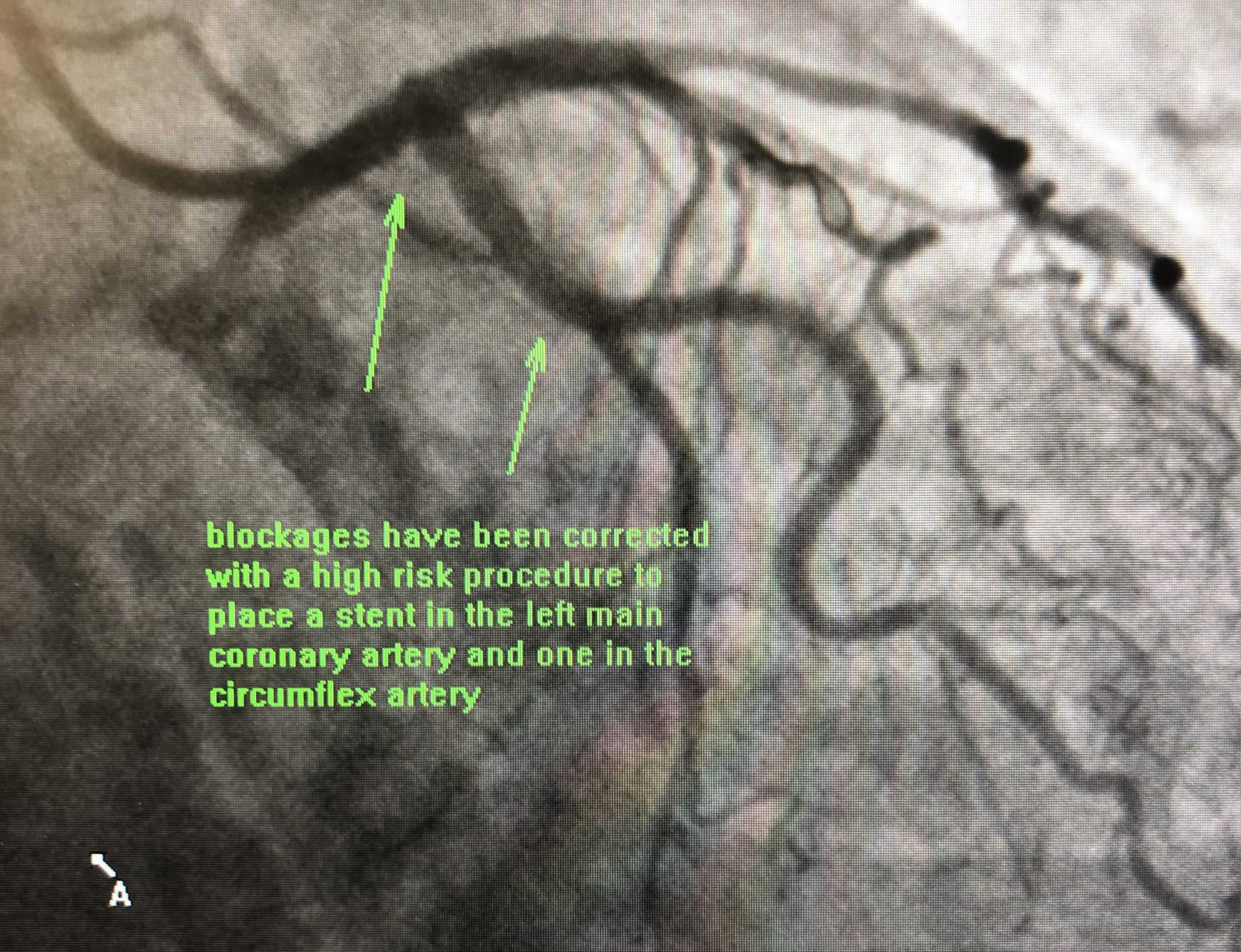 Cardiac Catheterization | Flemington NJ Cardiac Catheterization | Flemington NJ